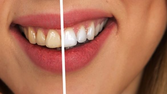 Que faut-il faire pour avoir des dents blanches?