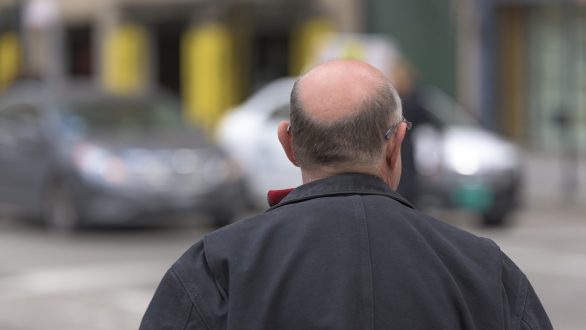 Comment traiter efficacement la calvitie